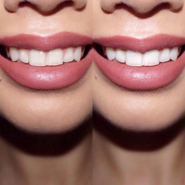 Play APK Teeth Whitening Tips  and enjoy Teeth Whitening Tips with UptoPlay com.HealthAndFitnessGuide.TeethWhiteningTips