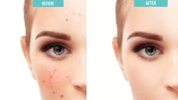 Play Acne Free : Pimple Remover