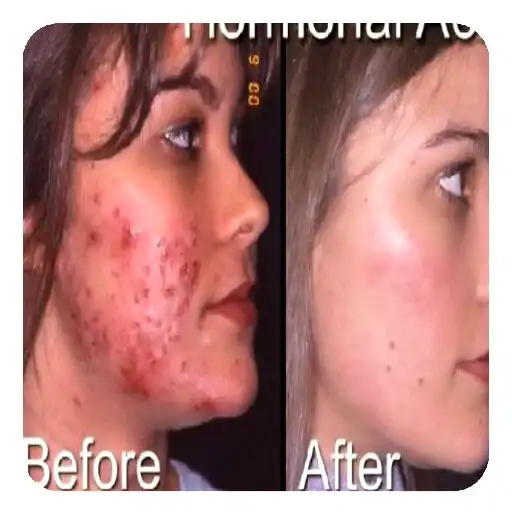 Play Acne (Guide) APK