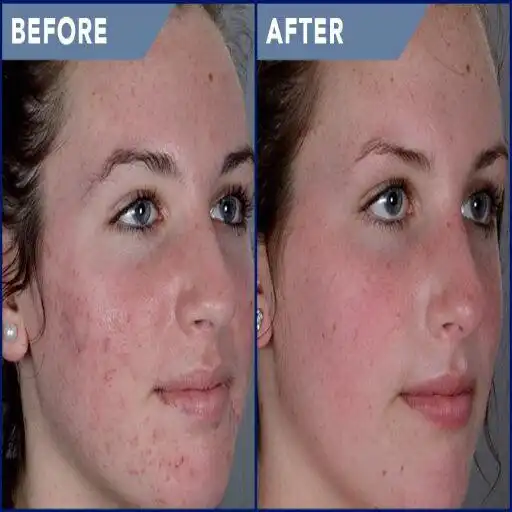 Play Acne (Guide) as an online game Acne (Guide) with UptoPlay
