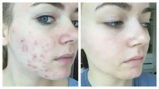 Play Acne Scars Remedies  and enjoy Acne Scars Remedies with UptoPlay