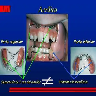 Play Activador de Frankel