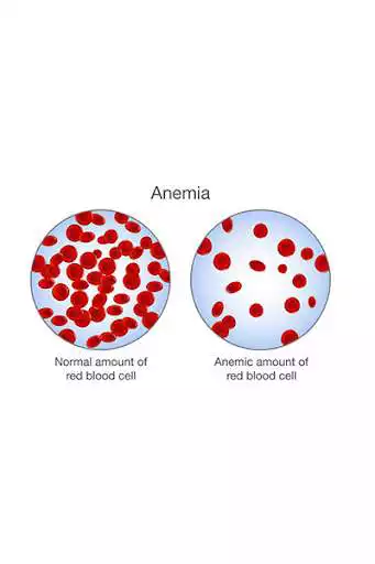 Play Anemia