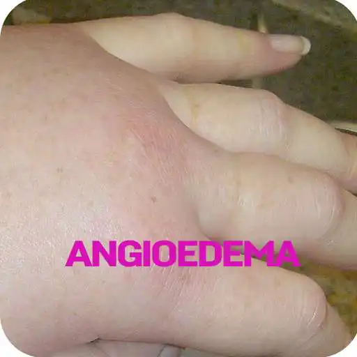 Free play online Angioedema Disease APK Free play online Angioedema Disease APK