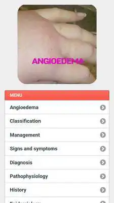 Play Angioedema Disease