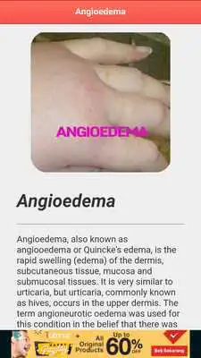 Play Angioedema Disease