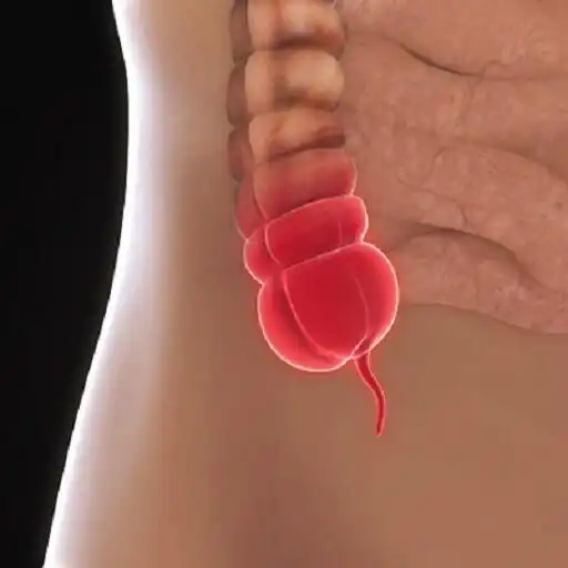 Play Appendicitis APK