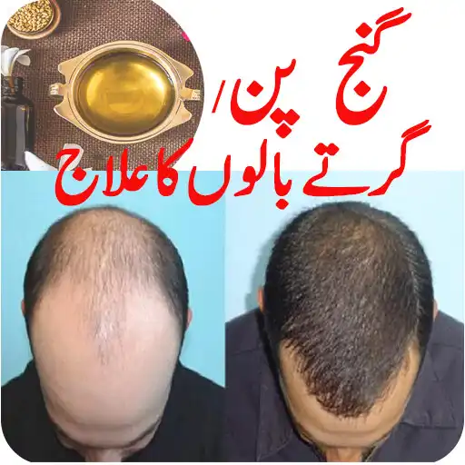 Play Balon k girny k ilaj-Hair loss APK