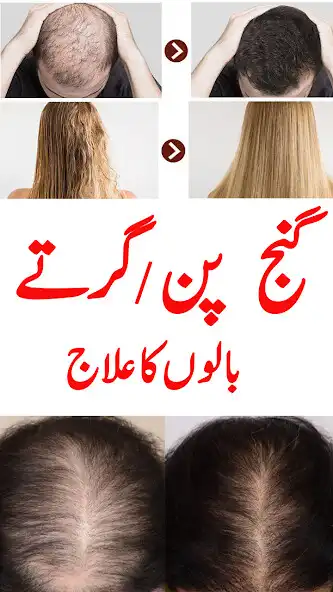 Play Balon k girny k ilaj-Hair loss as an online game Balon k girny k ilaj-Hair loss with UptoPlay