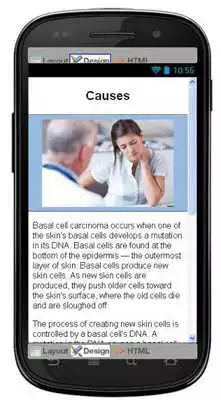 Play Basal Cell Carcinoma Disease