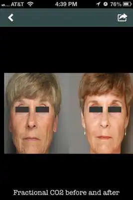 Play BodyLase Skin Spa