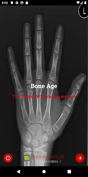 Play Bone Age  and enjoy Bone Age with UptoPlay