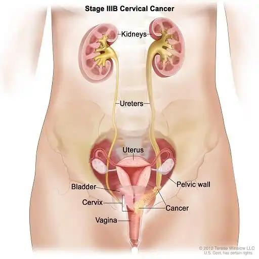Play Cervical Cancer - News APK Play Cervical Cancer - News APK
