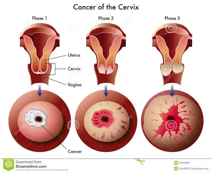 Play Cervical Cancer - News  and enjoy Cervical Cancer - News with UptoPlay