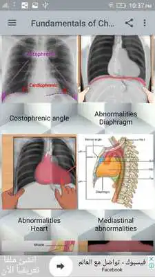 Play Chest X-Ray Interpretation