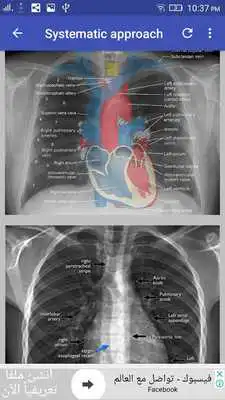 Play Chest X-Ray Interpretation