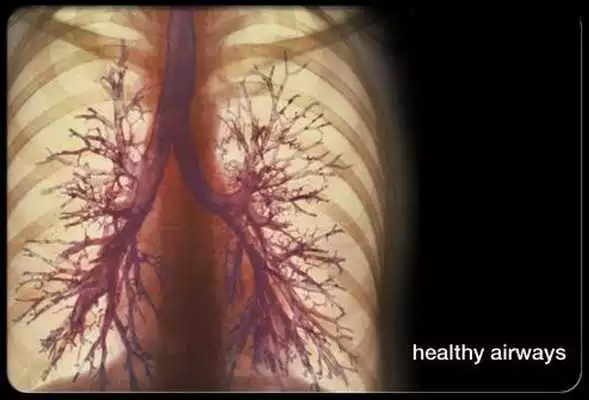Play Chronic Lung Disease