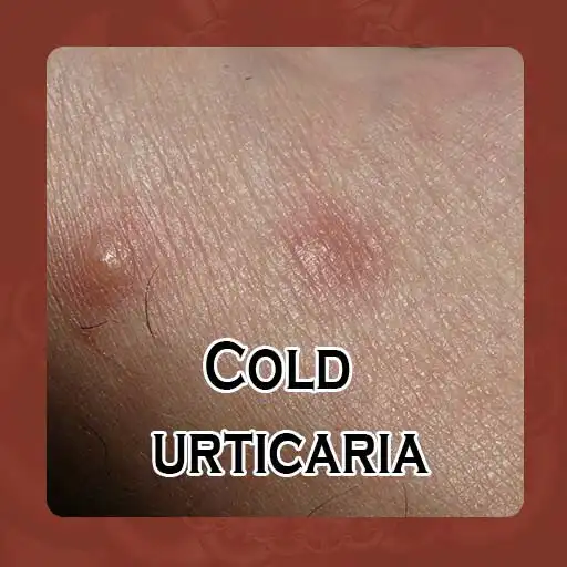 Play Cold urticaria - Causes, Diagn APK