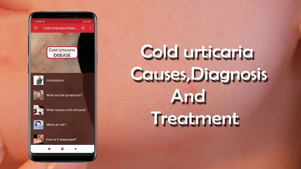 Play Cold urticaria - Causes, Diagn  and enjoy Cold urticaria - Causes, Diagn with UptoPlay