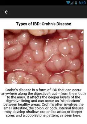 Play Crohns Disease Symptoms