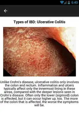 Play Crohns Disease Symptoms