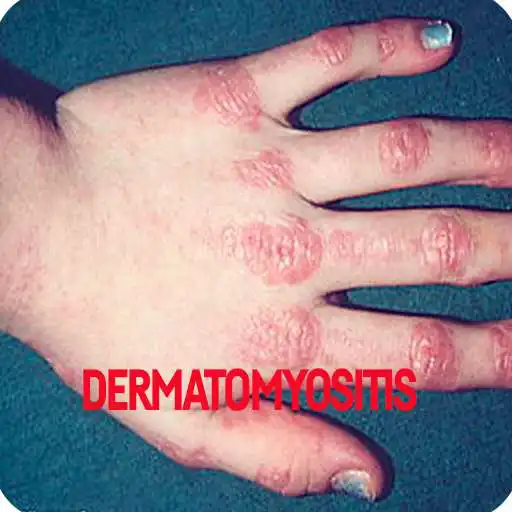 Free play online Dermatophytosis Infection APK Free play online Dermatophytosis Infection APK
