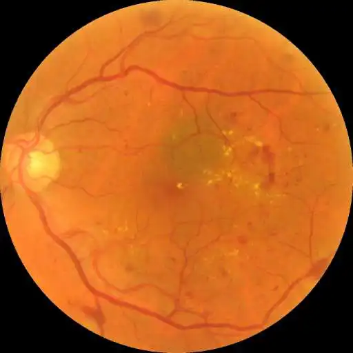Play Diabetic retinopathy predictor APK