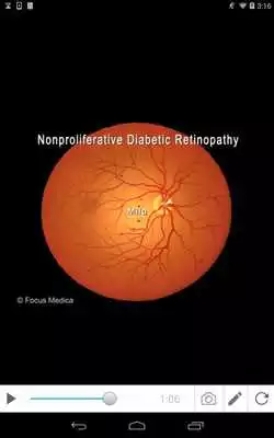 Play Diabetic Retinopathy