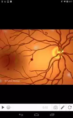 Play Diabetic Retinopathy
