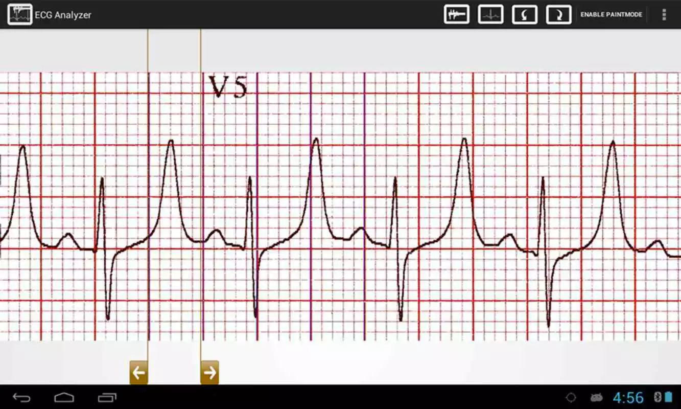Play ECG Analyzer