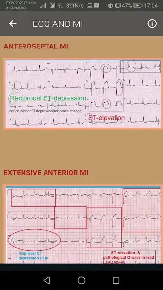 Play ECG Interpretation Part 2  and enjoy ECG Interpretation Part 2 with UptoPlay