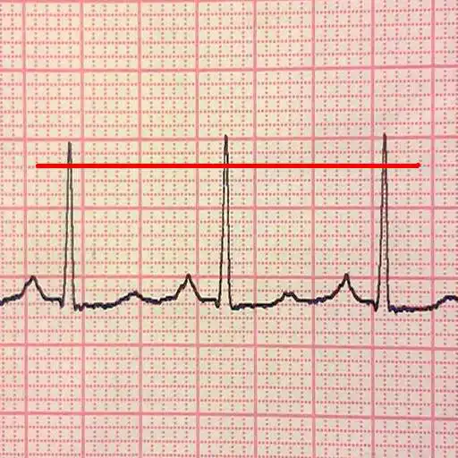 Play ECG Reader 2 free APK