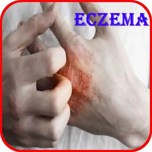 Play Eczema Causes, Diagnosis, and Management APK Play Eczema Causes, Diagnosis, and Management APK