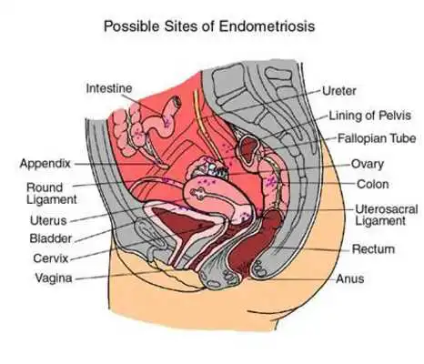 Play Endometriosis Treatment Play Endometriosis Treatment