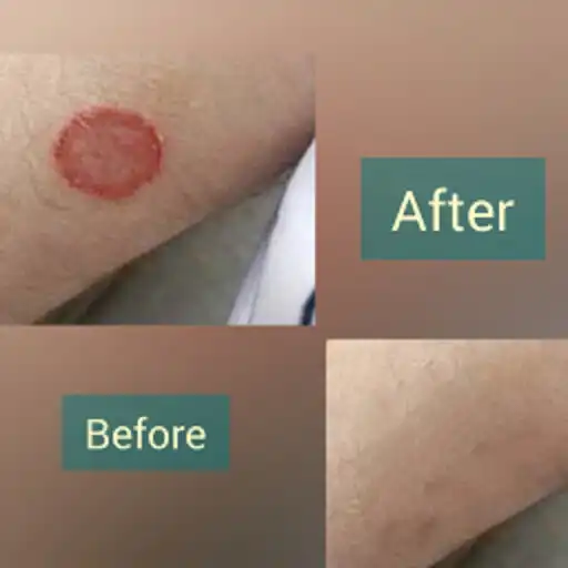 Play Fungal Infection Treatment APK Play Fungal Infection Treatment APK