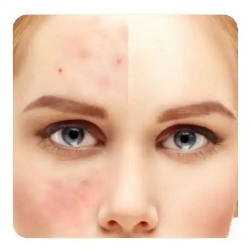 Play guide to Get rid of Acne APK Play guide to Get rid of Acne APK