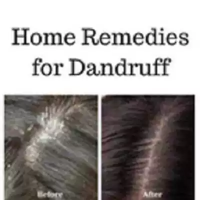 Play Home remedies for dandruff