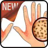 Free play online How to Cure Scabies APK