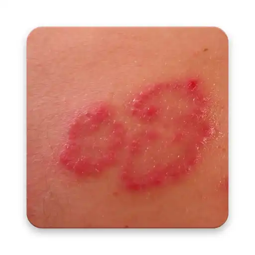 Free play online How to Cure Skin Rashes  APK