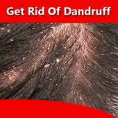 Free play online How to Get Rid of Dandruff (Natural Methods) APK Free play online How to Get Rid of Dandruff (Natural Methods) APK
