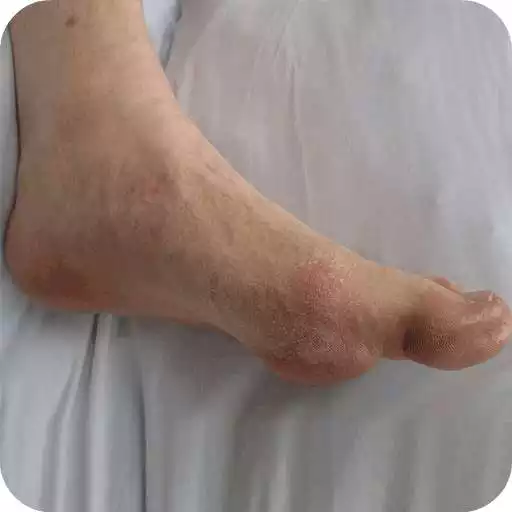 Free play online How to Get Rid of Gout APK Free play online How to Get Rid of Gout APK