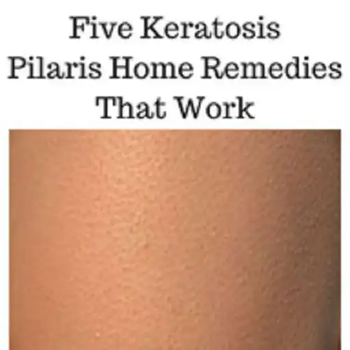 Free play online Keratosis Pilaris Treatment APK