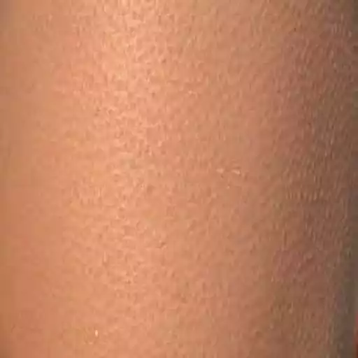 Play Keratosis Pilaris Treatment