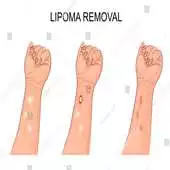 Free play online Lipoma Solution Disease APK