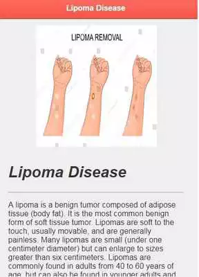 Play Lipoma Solution Disease Play Lipoma Solution Disease