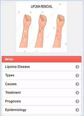 Play Lipoma Solution Disease Play Lipoma Solution Disease