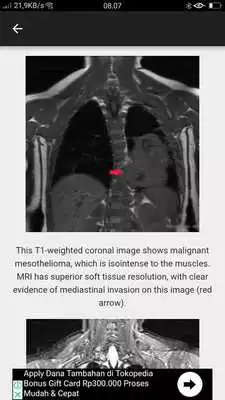 Play MESOTHELIOMA IMAGING Play MESOTHELIOMA IMAGING