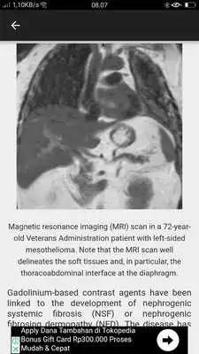 Play MESOTHELIOMA IMAGING Play MESOTHELIOMA IMAGING