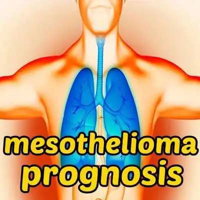 Play Mesothelioma Prognosis Symptom