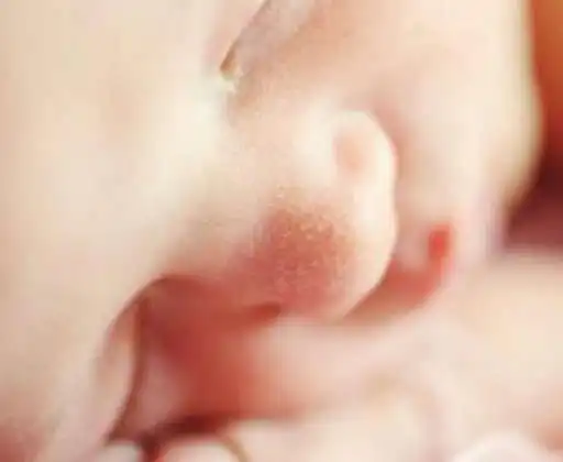 Play Milia in Babies Remedies  and enjoy Milia in Babies Remedies with UptoPlay